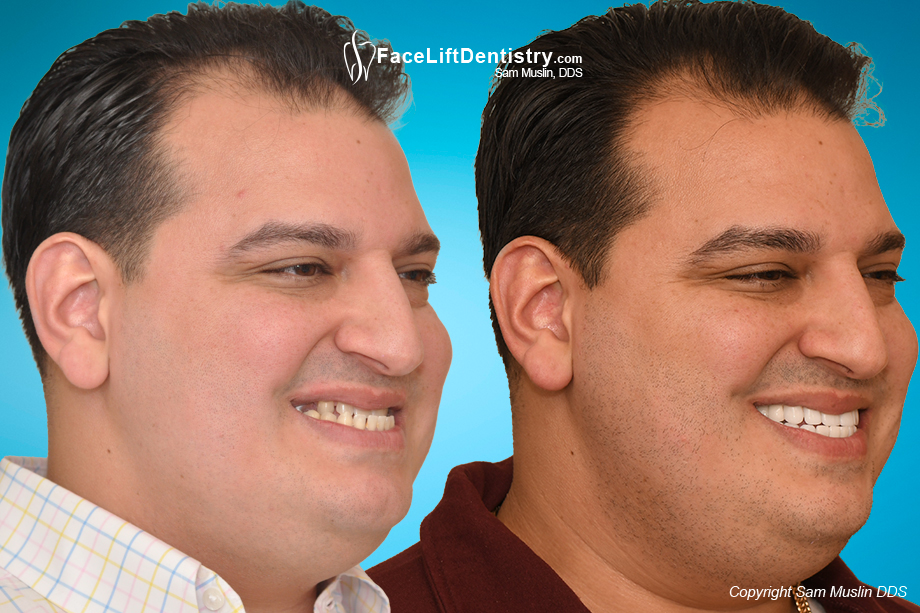 Misaligned jaw and malocclusion treated without corrective jaw 
																		   surgery.