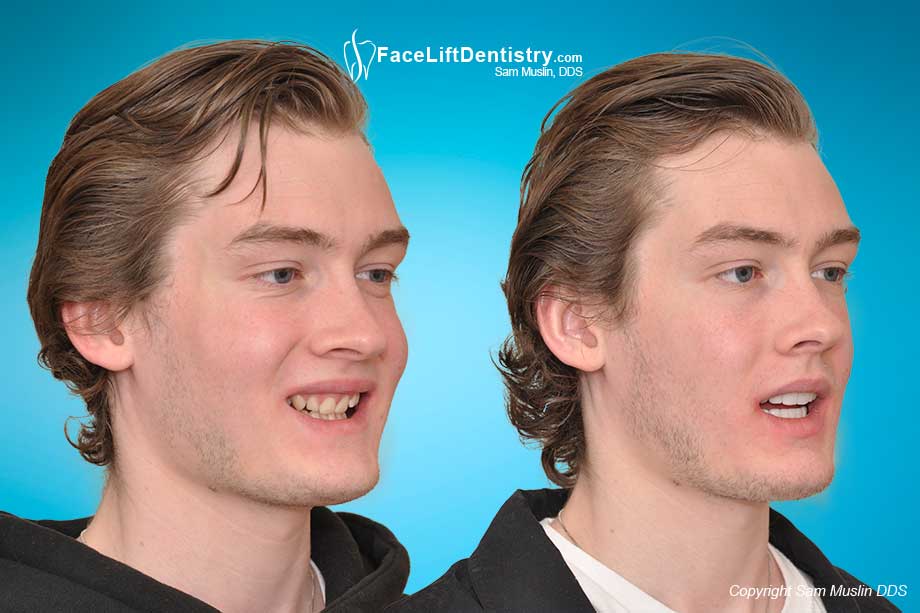 Jaw Surgery for Deep Bites Alternative - Before and After