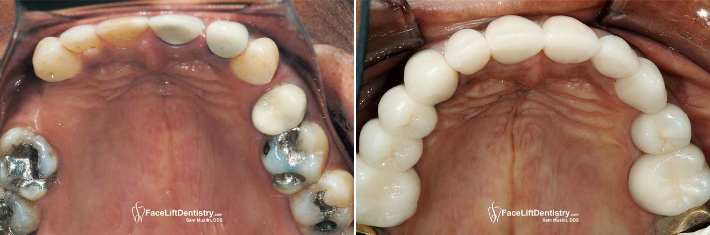 Bicuspid Teeth Extraction Reversed - Closeup Before and After