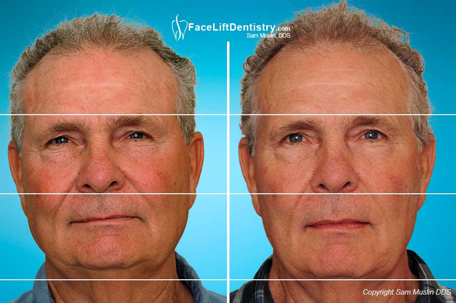 Reversing Aging caused by  Bite Collapse