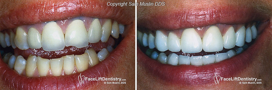 Cheap bad porcelain crowns with black gum lines in the first picture is now fixed with high quality porcelain crowns