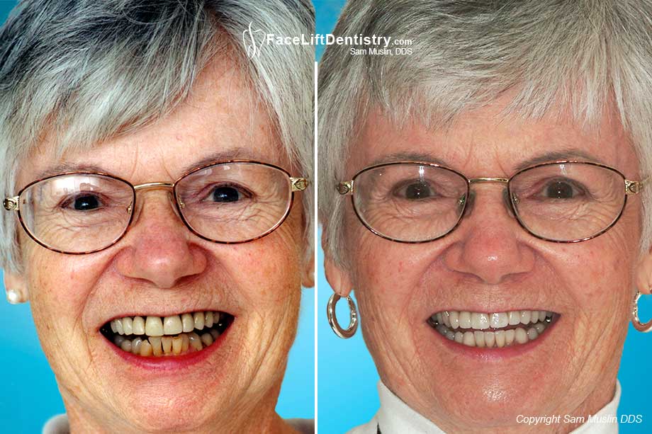  Black gum lines after porcelain crowns.