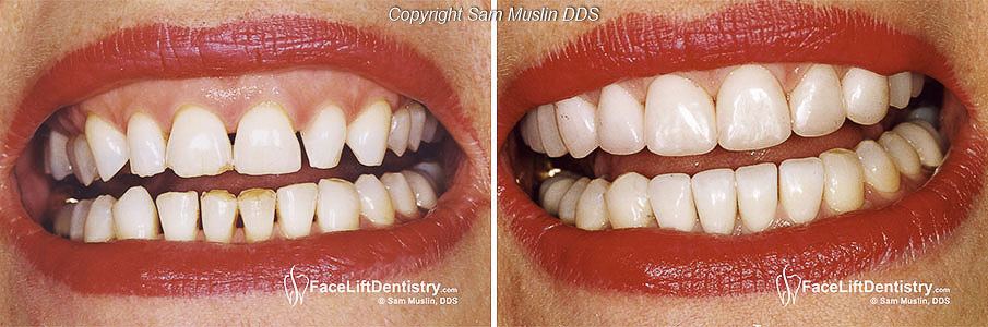 What can cause dark gums around someone's teeth?