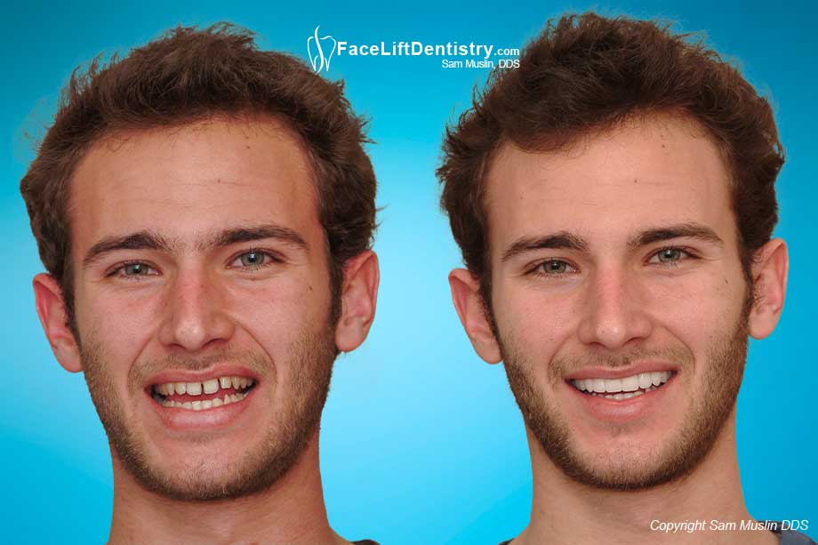 A before-and-after photo showing no gaps and straight teeth after being treated with ultra-thin no-prep porcelain veneers rather than braces.