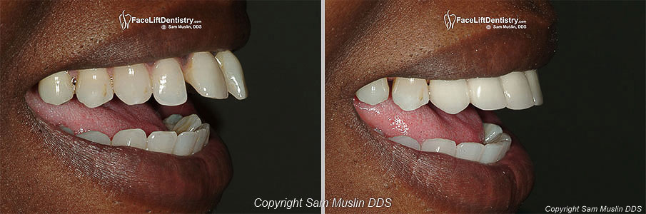 Buck Teeth Before and After: The angles of her upper two teeth are not in a...