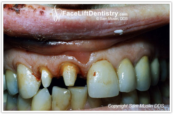  Implants using ceramic posts and crowns