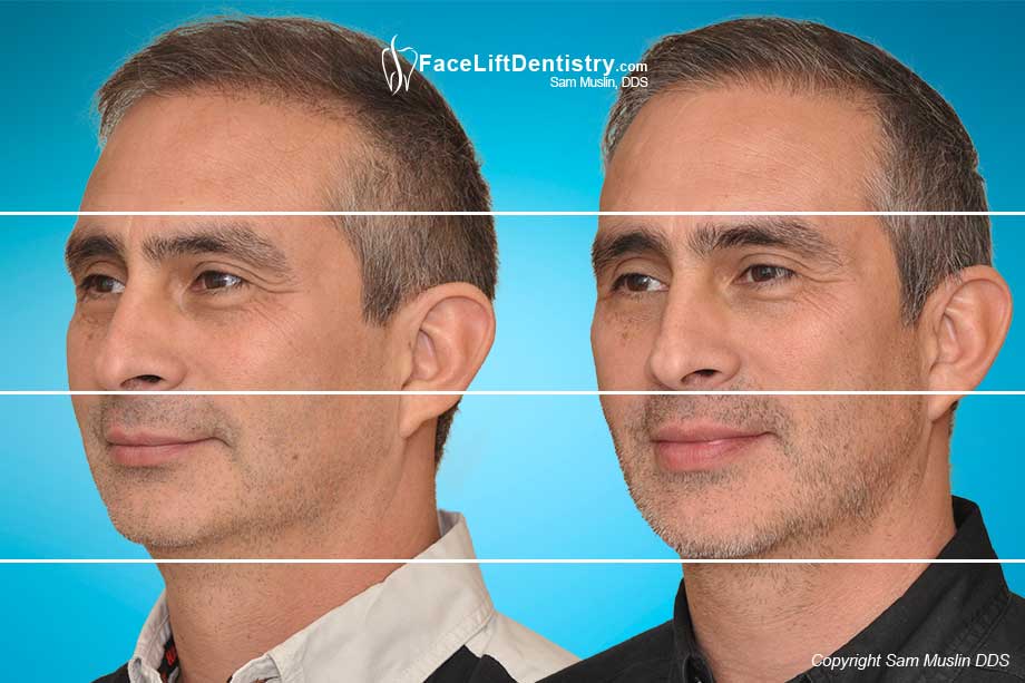 Changing the shape of the face without surgery - before and after
