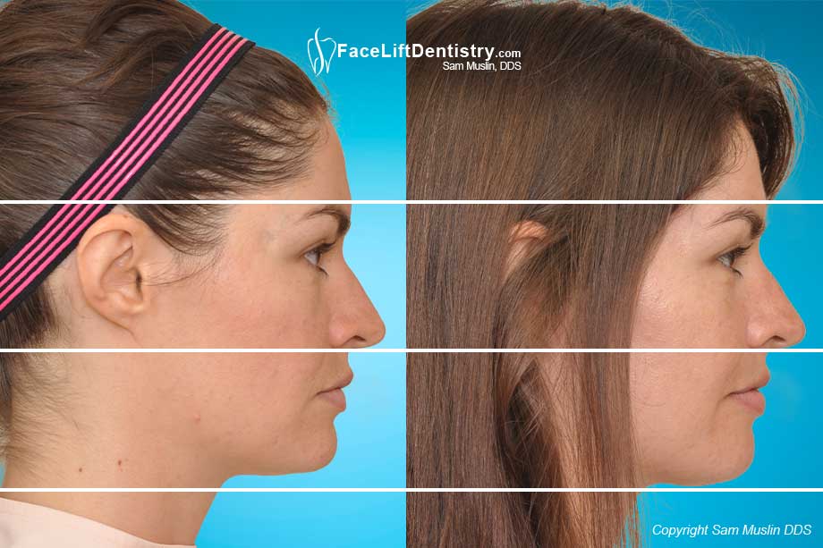 Her Chin Size and Profile improved after VENLAY Restorations