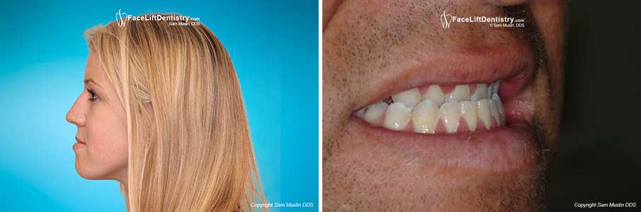 Protruding Jaw fixed Without Surgery or Braces