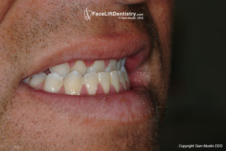 malocclusion