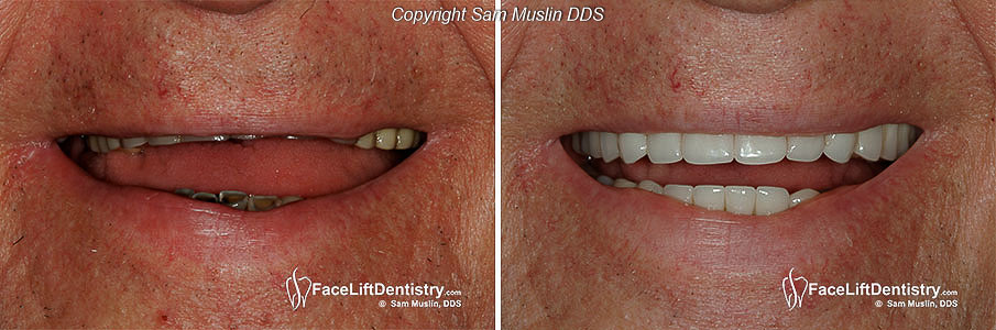 The collapsed mouth - Before and After full mouth reconstruction