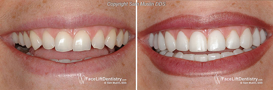  The before and after smile showing uneven edges and teeth worn down from grinding, restored to a perfect natural looking smile with non invasive veneers.