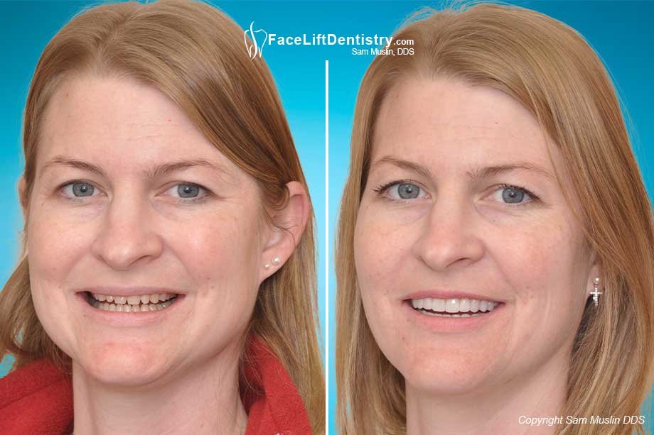 Collapsed Bite reconstruction - before and after VENLAY<sup>®</sup> reconstruction treatment