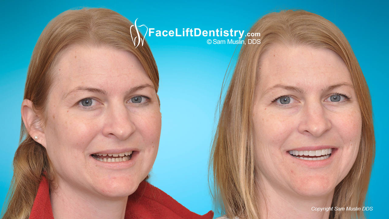 facial profile correction, before and after treatment with facelift dentistry