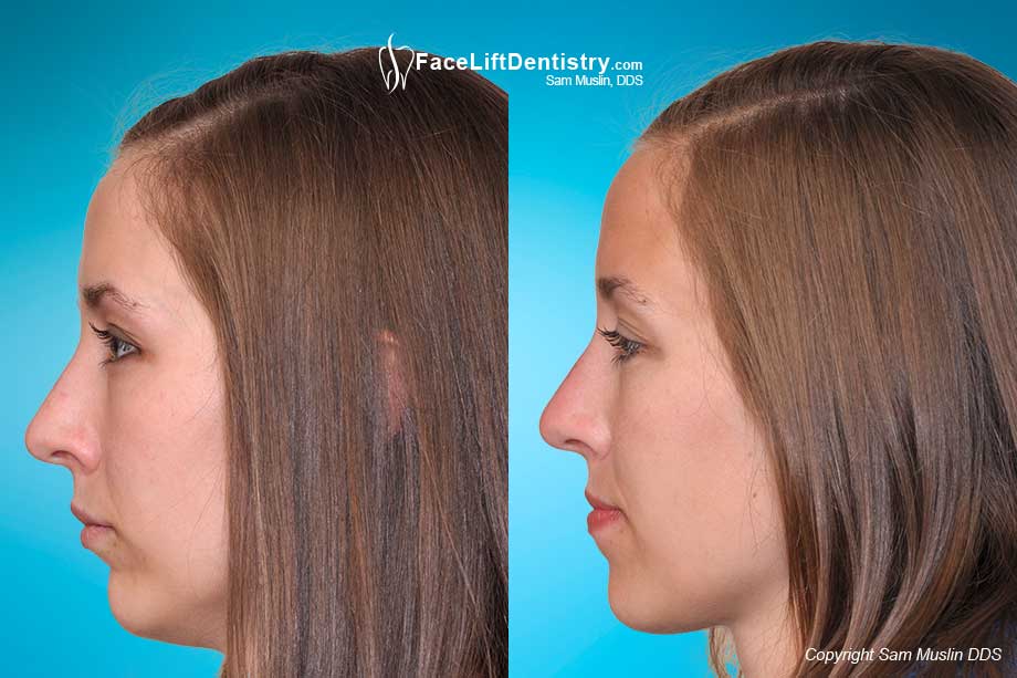 Before and after her misaligned jaw and small chin was corrected. The shape of the face was improved by moving the jaw position forward without surgery.