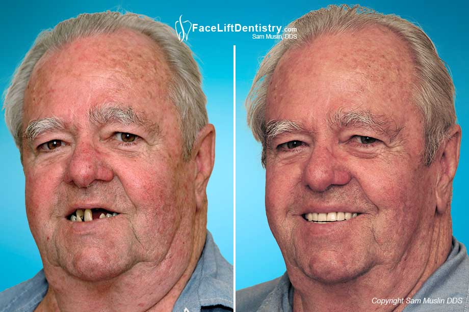  The photo on the left shows tooth loss due to gum disease. The photo on the right shows the same patient after full mouth reconstruction.