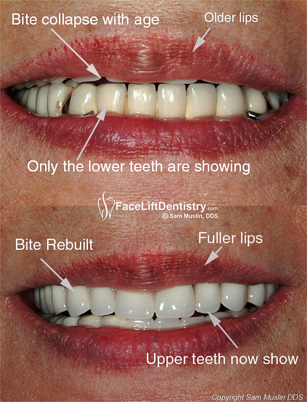 A close-up view showing bite collapse in the before photo due to worn down teeth. Only her lower teeth are showing. In the after photo her bite has been corrected, showing balanced teeth and fuller lips.