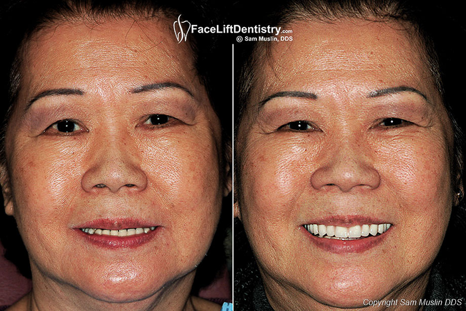 Before and After Facelift Dentures