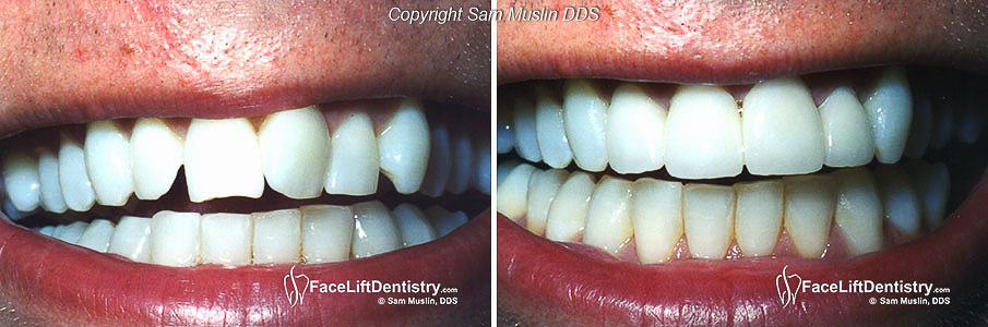  Before andafter photo showing crooked teeth straightened in 2 weeks with instant braces.