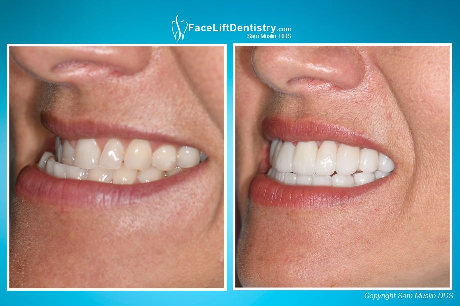 Closeup photo showing a patient with a crossbite, before and after treatment.