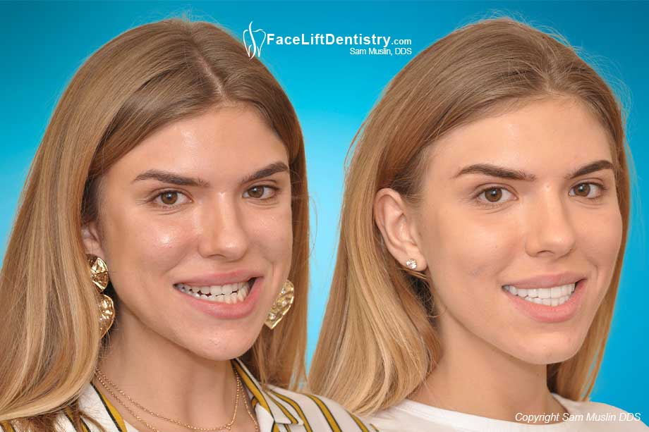 Crossbite corrected without surgery, braces, or drilling down teeth. Before and After Crossbite Correction.