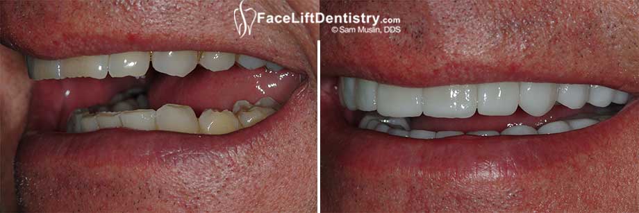 Closeup showing the aggravated tooth wear caused by an over bite