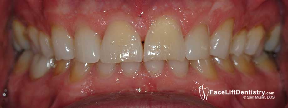 Closup photo showing the deep over bite of a maturing adult