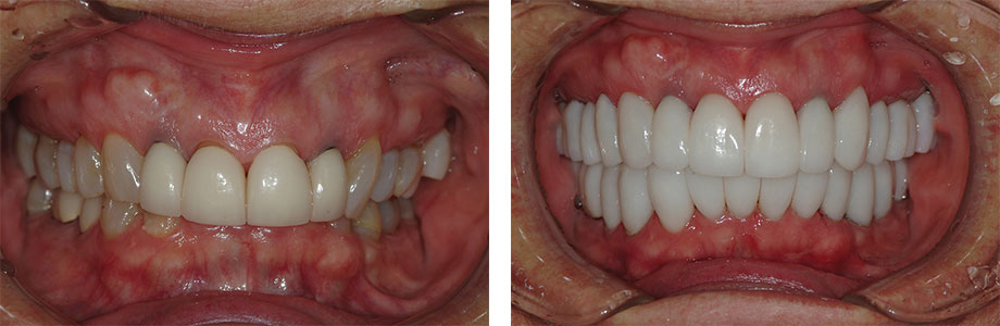 Closeup photo showing a deep overbite which cause the lower jaw and chin to be pushed back resulting in a small-looking chin.