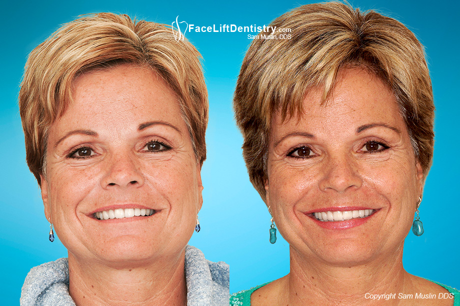 Before and After photo showing a patient with a deep overbite and the corrected outcome