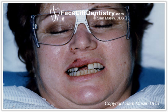  Teeth Broken Off at Gum Level - An Example of a Dental Accident