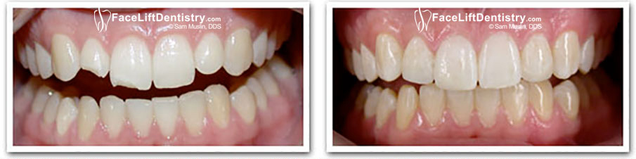  Dental Bonding on Front Teeth - Before and After