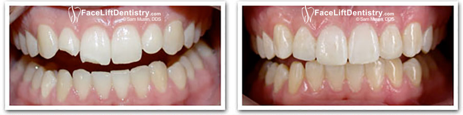 Dental Bonding on Front Teeth