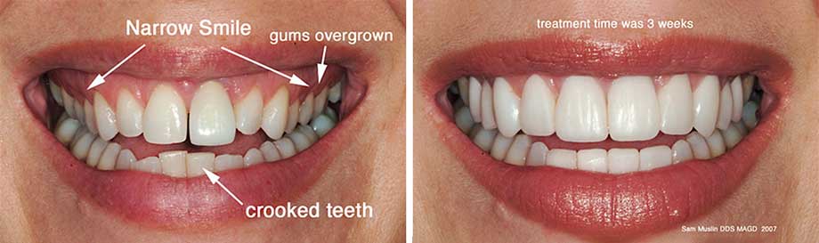 A closeup showing the outcome of dental veneer treatment to widen a smaile and address crooked teeth and overgrown gums.