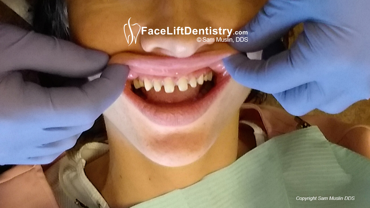 small teeth and overbite corrected for a better profile, before and after