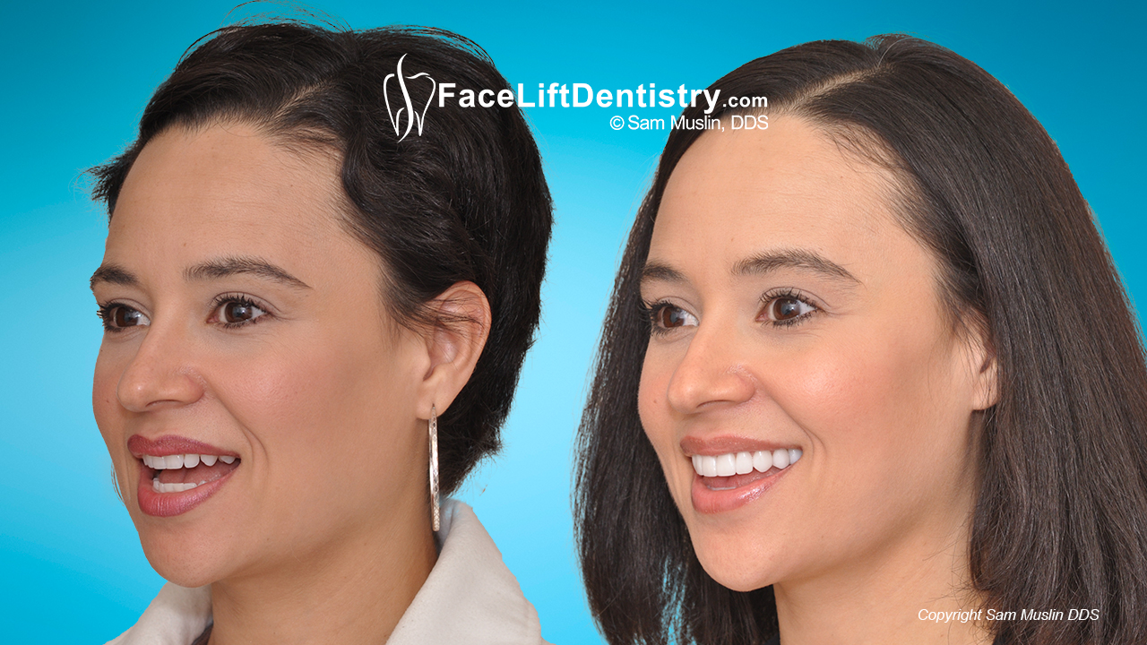 Small chin and overbite corrected for a better profile, before and after