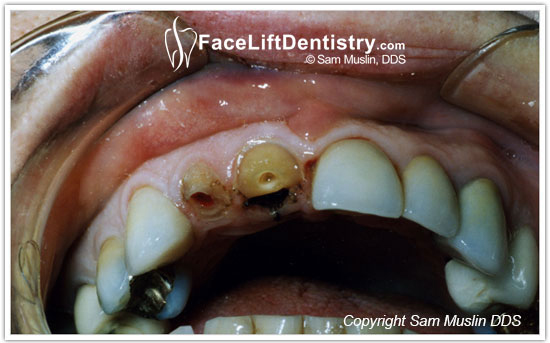  Exposed Tooth Nerves after Dental Accident