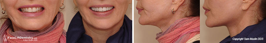 Facial Profile Enhancement with Face Lift Dentistry® This series of photos show that Face Lift Dentistry® goes beyond cosmetic dentistry by radicaly enhancing the patient's profile resulting in a much younger look.