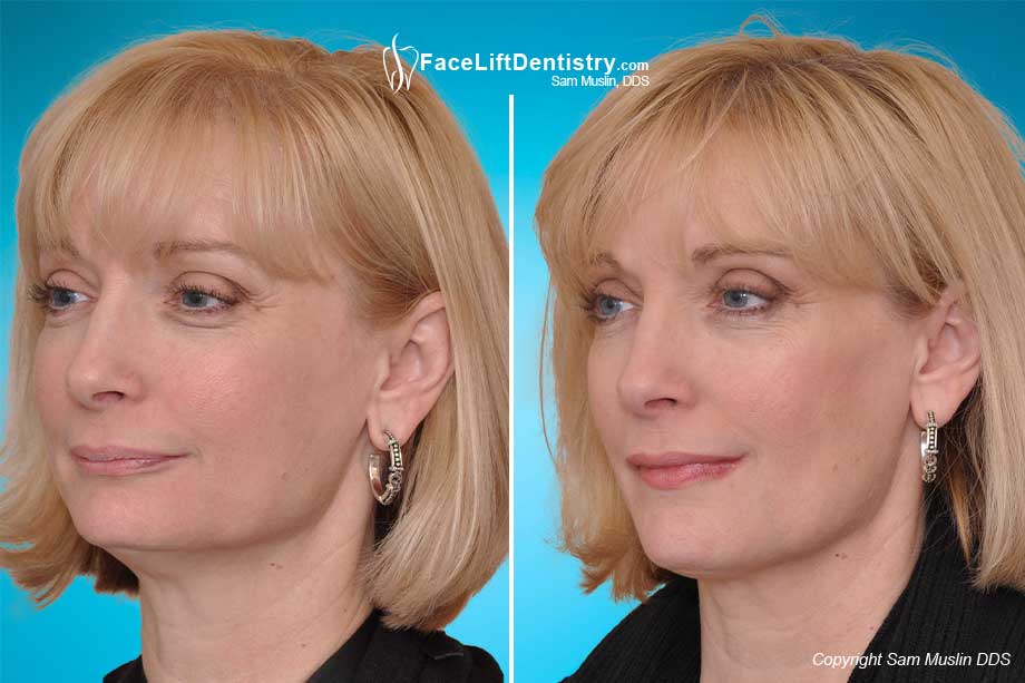 Bite Correction to improve facial profiles - before and after