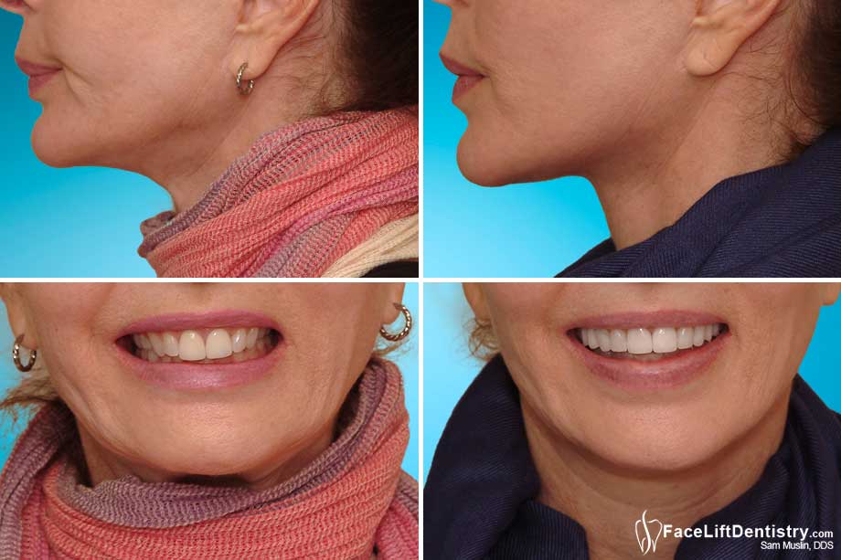Side profile and full facial optimization with non-invasive Face Lift Dentistry - Before and After