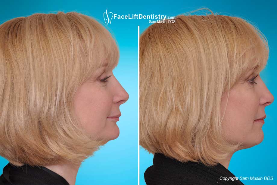 Example of a patient with a deep overbite, before and after treatment.