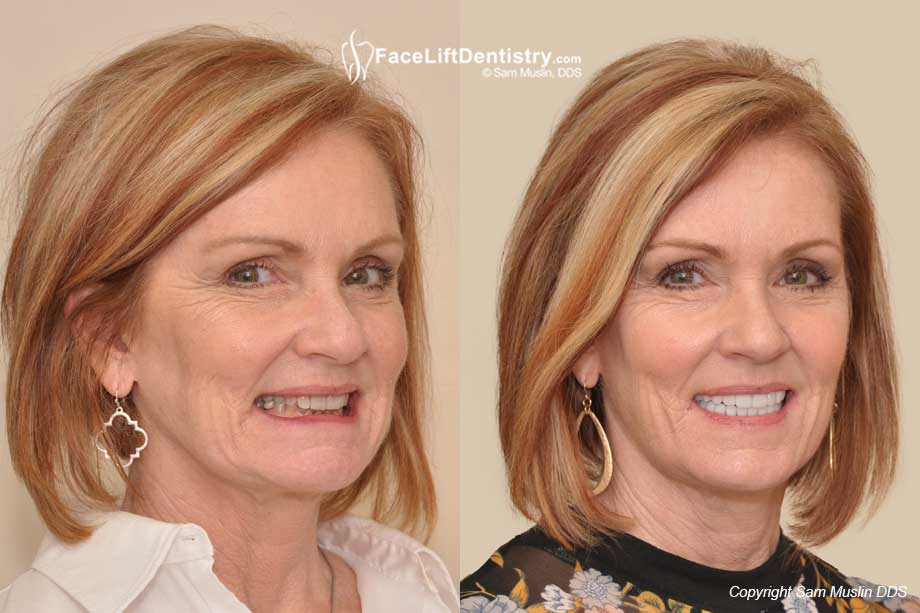 The photo shows a wider smile and younger face after a non-surgical facelift with the Face Lift Dentistry method