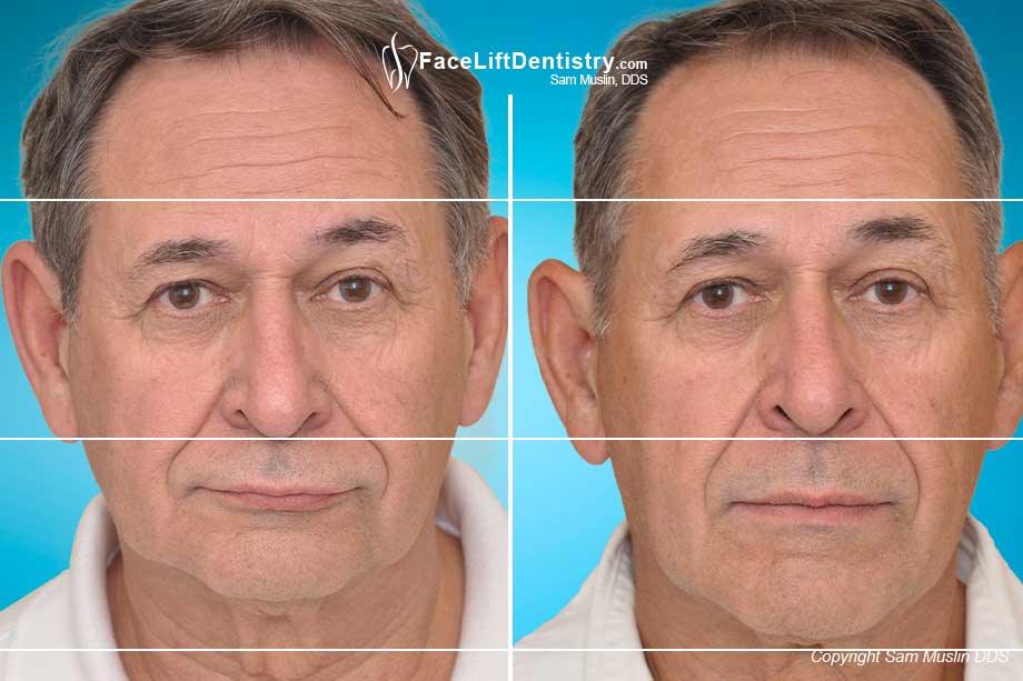 Facial Collapse can be restored once the crooked jaw is aligned and the bite corrected - before and after