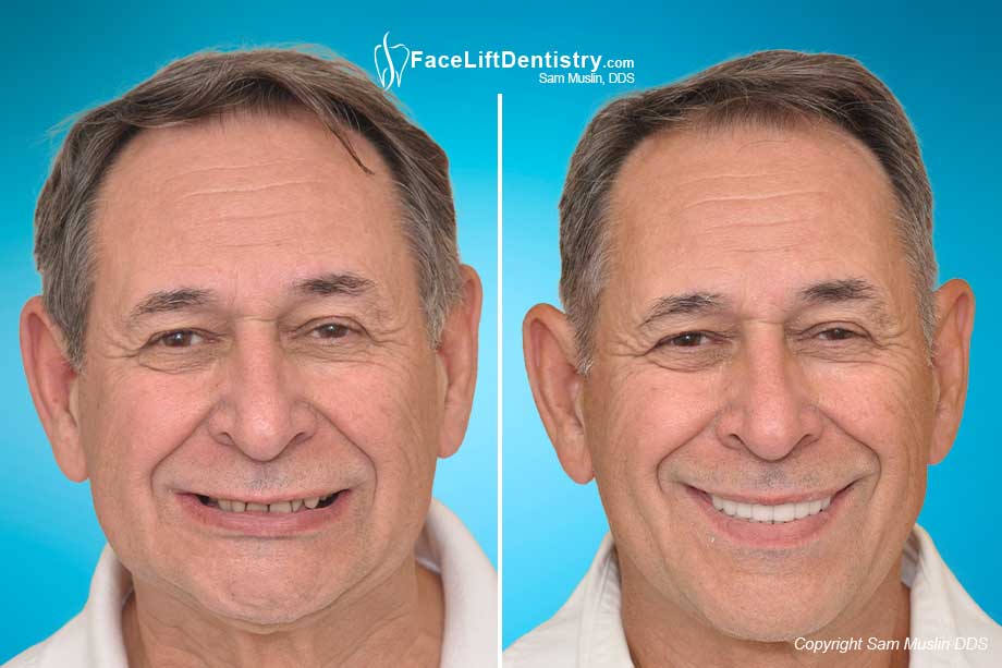 Reversing the effects of aging with jaw alignment and bite correction.