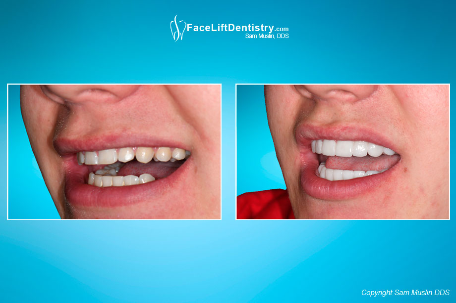 Failed traditional orthodontics - before and after VENLAY® correction