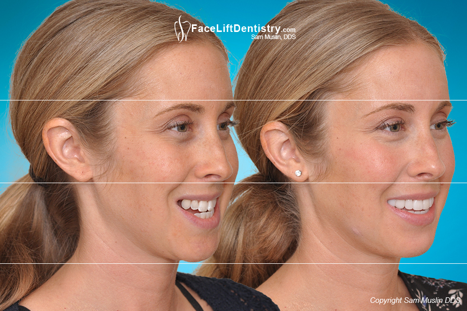 Bicuspid extraction and orthodontics ruined her face. Before and after treatment with JawTrac® and VENLAY®.