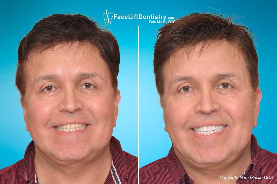 Before and After failed jaw surgery was corrected with non-surgical VENLAY Restorations.