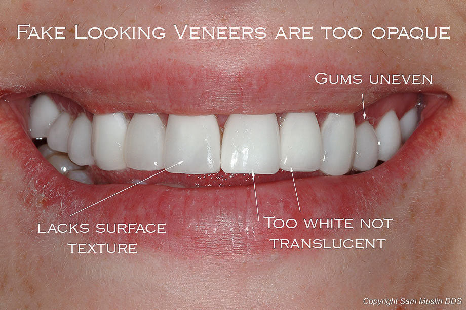 Fake-looking veneers example