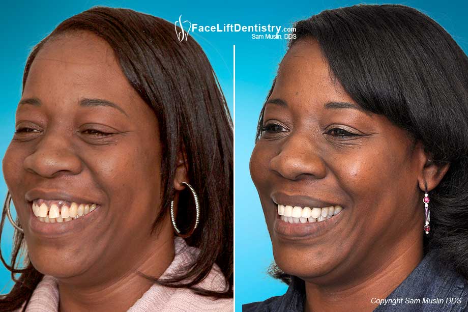 Buck Teeth: Causes, Symptoms And Treatments For Overjet