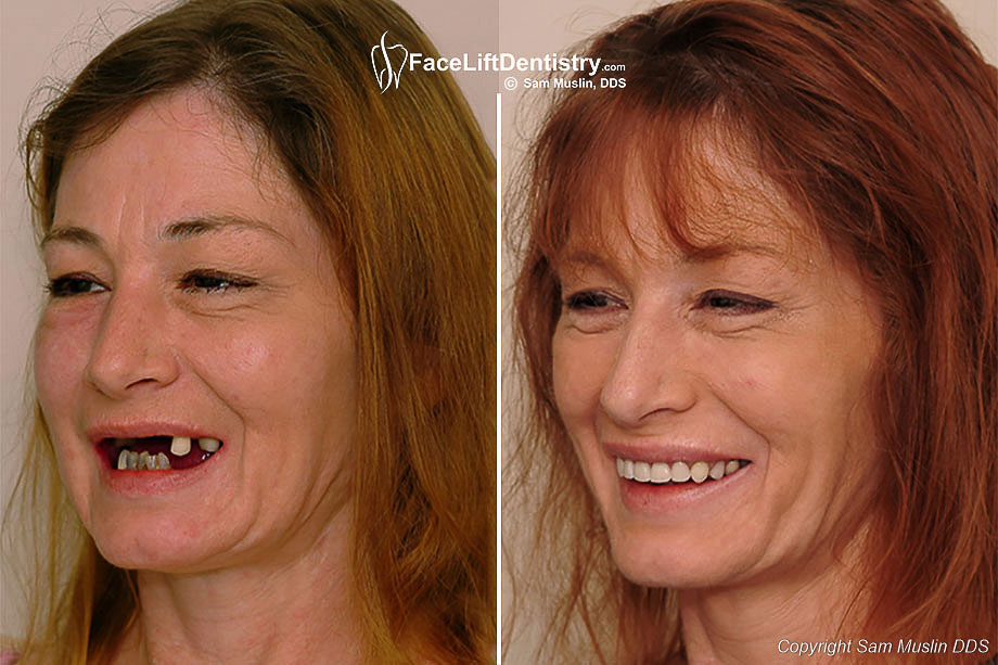 Treatment with Facelift Dentistry - Before and After