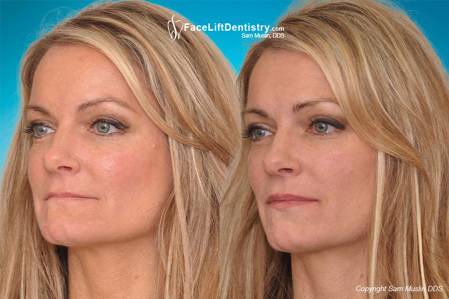 Reversing the Aging Process - Before and After Treatment